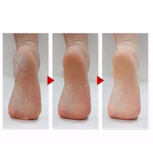 صورة جوارب سحرية لتقشير القدمين من ام بيوتي