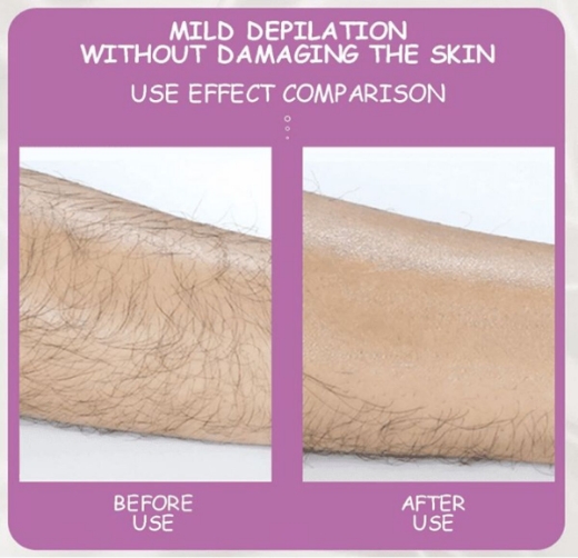 صورة إزالة الشعر بالكريستال